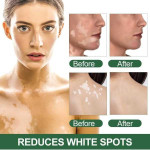 Sumifun Vitiligo Care Cream 20G